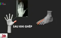Kỹ thuật cấy ghép ngón chân thành ngón tay cái
