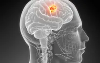 Khả năng chữa ung thư não từ virus Zika