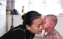 Việc tử tế: Người mẹ của những đứa con ly thượng bì bóng nước