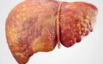 Nam giới Việt mắc ung thư gan cao thứ 3 thế giới