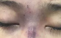 Tự học nghề thẩm mỹ, người chồng tiêm filler làm mù mắt vợ