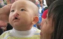 Phẫu thuật miễn phí cho trẻ dị tật khe hở môi vòm miệng