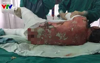 Cảnh báo tổn thương da nghiêm trọng do dị ứng thuốc