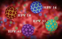 Các giai đoạn phát triển của ung thư cổ tử cung do nhiễm HPV
