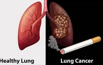 Những bệnh ung thư liên quan tới thuốc lá
