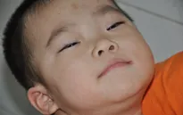 Sặc cháo, bé 3 tuổi bị tổn thương não trầm trọng