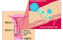 Vi rút HPV có nguy hiểm không?
