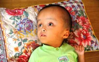 Xót xa bé gái 3 tuổi mắc bệnh não úng thủy nằm chờ chết ở nhà tình thương