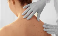 Những cách phát hiện ung thư da, bạn cần biết