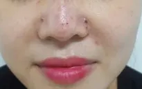Thêm một ca biến chứng sau khi tiêm filler tại spa