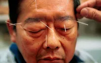 Y học cổ truyền Trung Quốc được áp dụng để điều trị trầm cảm tại Mỹ