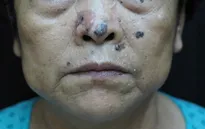 Các yếu tố nguy cơ gây ung thư da