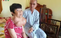 Người phụ nữ 35 năm mang khối bướu gần 10kg trên cổ