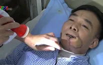 Nguy cơ ung thư khoang miệng vì hút thuốc lá