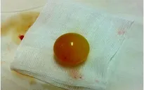 Nguy hiểm: Trẻ nuốt phải hạt nở