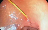 Chiếc tăm nhọn găm vào dạ dày tạo thành ổ loét