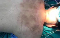Tê liệt chân vì chữa thoát vị đĩa đệm bằng giác hơi