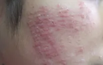 Tai biến do lăn kim, tiêm vi điểm
