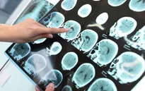 Bệnh mất trí nhớ alzheimer có sự khác biệt theo giới tính