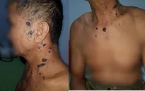 Người đàn ông mắc hội chứng đa ung thư da liên quan tới di truyền