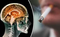 Hút thuốc lá làm tăng nguy cơ ung thư phổi di căn lên não