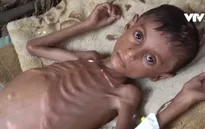 Khoảng 20 triệu người thiếu ăn, Yemen đứng bên bờ vực của nạn đói