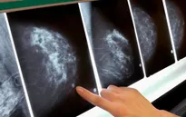 Hiệu quả bất ngờ khi kết hợp vaccine và thuốc miễn dịch để chống ung thư vú