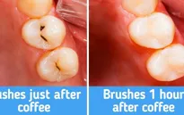7 lời khuyên từ chuyên gia giúp răng trắng và khỏe mạnh