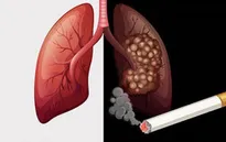 Thuốc lá cướp đi mạng sống của nhiều người hơn COVID-19