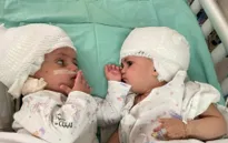 Israel tách thành công cặp song sinh dính liền đầu sau ca phẫu thuật kéo dài 12 giờ