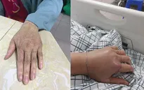 Cứu sống kịp thời người bệnh bị rắn lục cắn