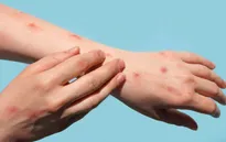 Virus đậu mùa khỉ lây truyền 4 ngày trước khi các triệu chứng bệnh xuất hiện