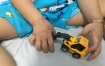 TP Hồ Chí Minh: Nguy cơ "dịch chồng dịch" từ bệnh sốt xuất huyết và tay chân miệng