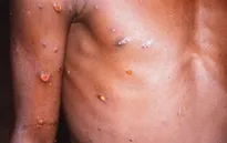 Thêm 4 trường hợp nhiễm bệnh đậu mùa khỉ hiếm gặp được xác nhận ở Anh