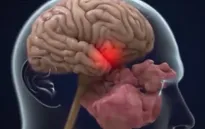 Người mắc COVID-19 thể nặng bị mất tới 10 điểm IQ