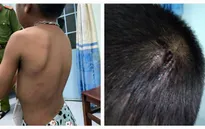Bắt giam người cha bạo hành con đẻ 6 tuổi
