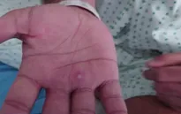 Nhiều quốc gia tăng cường đối phó bệnh đậu mùa khỉ