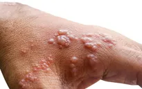 Canada đẩy mạnh tiêm vaccine phòng đậu mùa khỉ