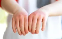 Các triệu chứng sốc nhiệt ở trẻ em và cách phòng tránh sớm