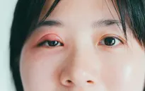 Tại sao lại xuất hiện “mụn” ở mắt?