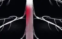 Công nghệ kích thích tủy sống giúp bệnh nhân Parkinson đi lại