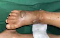Cảnh báo nguy cơ bị rắn cắn khi trời mưa nhiều