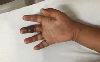 Cảnh báo tình trạng rắn cắn trong mùa mưa