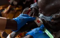 Dịch sởi và tình trạng suy dinh dưỡng khiến hơn 1.200 trẻ em ở Sudan tử vong