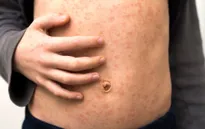 Hơn một nửa thế giới đối mặt với nguy cơ cao mắc bệnh sởi