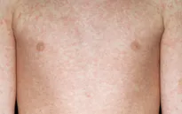 WHO cảnh báo số ca mắc sởi gia tăng trở lại ở châu Âu