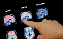 Trí tuệ nhân tạo giúp phát hiện sớm bệnh Alzheimer