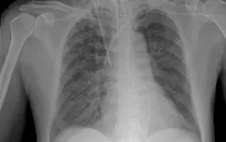 Bộ Y tế thông tin về các trường hợp mắc bệnh do virus gây viêm phổi trên người tại Trung Quốc