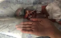Hy hữu hai trẻ sinh đôi ra đời cách nhau 3 ngày