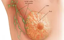 Đột phá về công nghệ nano thắp lên hy vọng điều trị ung thư vú ác tính